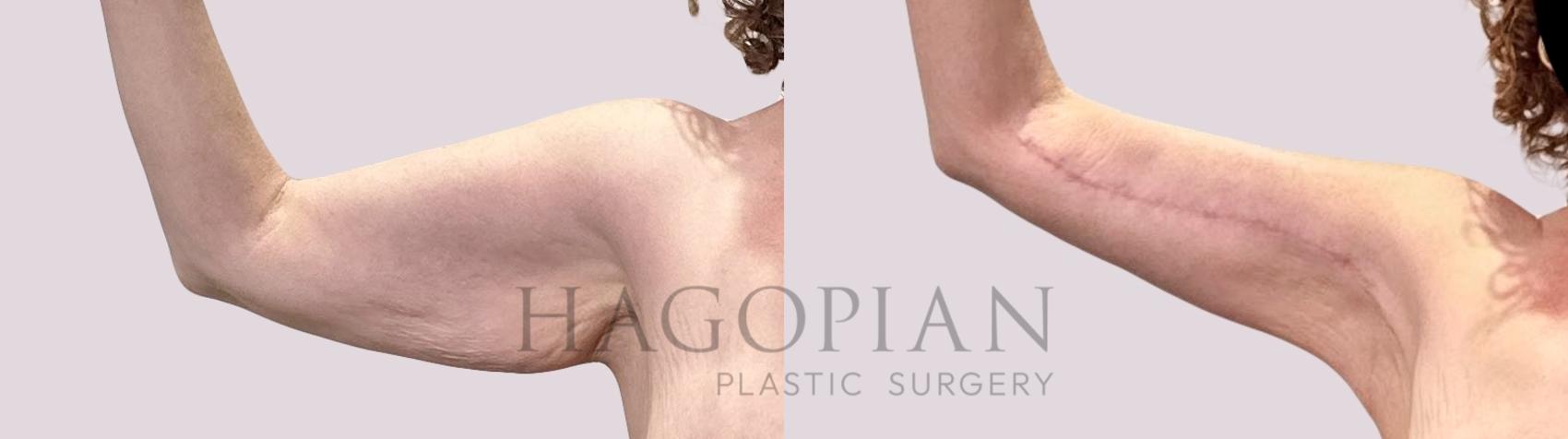 Before & After Arm Lift Case 208 Left Side View in Atlanta, GA