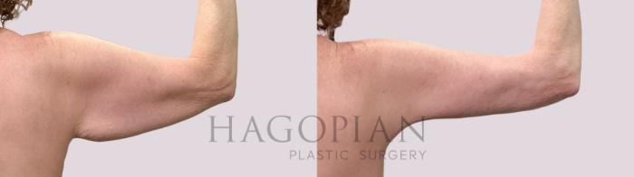 Before & After Arm Lift Case 208 Right Oblique View in Atlanta, GA