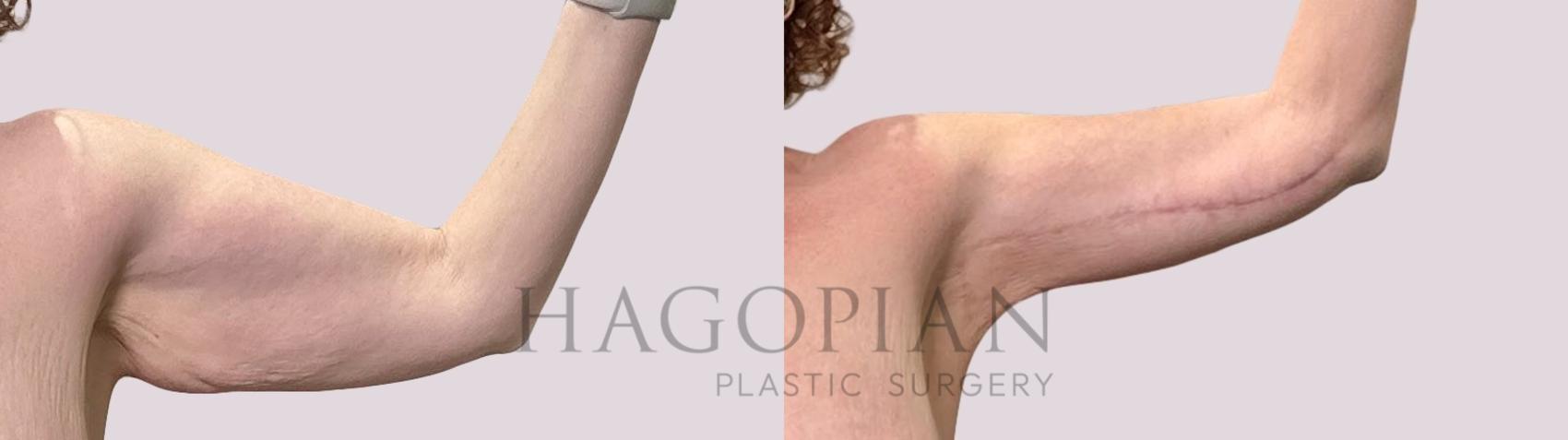 Before & After Arm Lift Case 208 Right Side View in Atlanta, GA