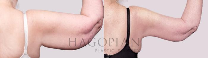 Before & After Arm Lift Case 21 Back 2 View in Atlanta, GA