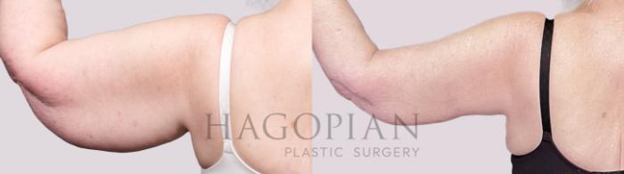 Before & After Arm Lift Case 21 Back View in Atlanta, GA