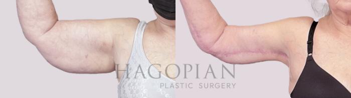 Before & After Arm Lift Case 21 Right Side View in Atlanta, GA