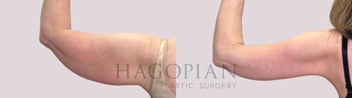 Before & After Arm Lift Case 210 Left Oblique View in Atlanta, GA