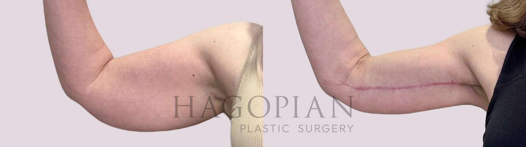 Before & After Arm Lift Case 210 Left Side View in Atlanta, GA