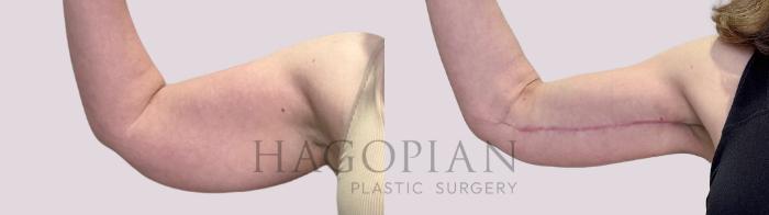 Before & After Arm Lift Case 210 Left Side View in Atlanta, GA