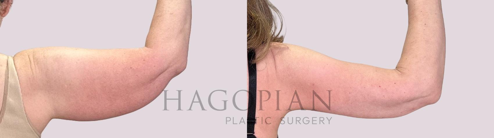 Before & After Arm Lift Case 210 Right Oblique View in Atlanta, GA