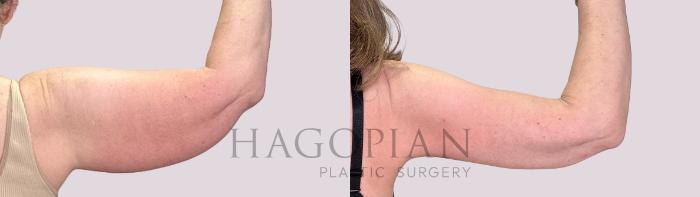 Before & After Arm Lift Case 210 Right Oblique View in Atlanta, GA