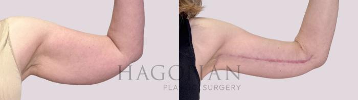 Before & After Arm Lift Case 210 Right Side View in Atlanta, GA