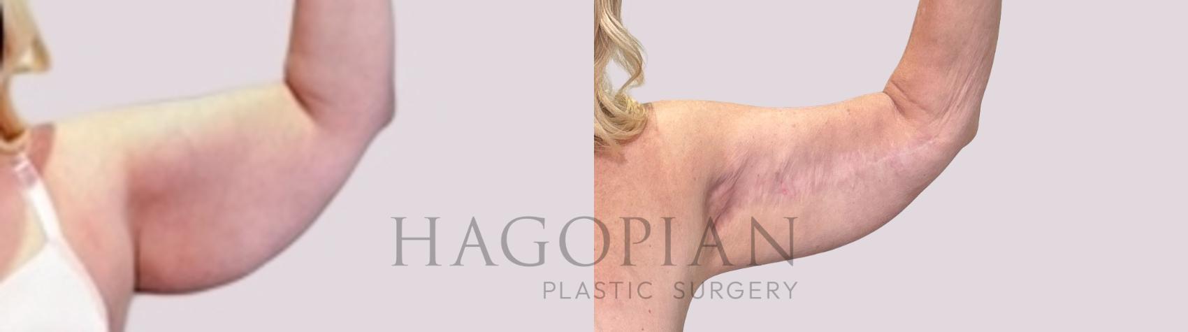 Before & After Arm Lift Case 217 Left Oblique View in Atlanta, GA