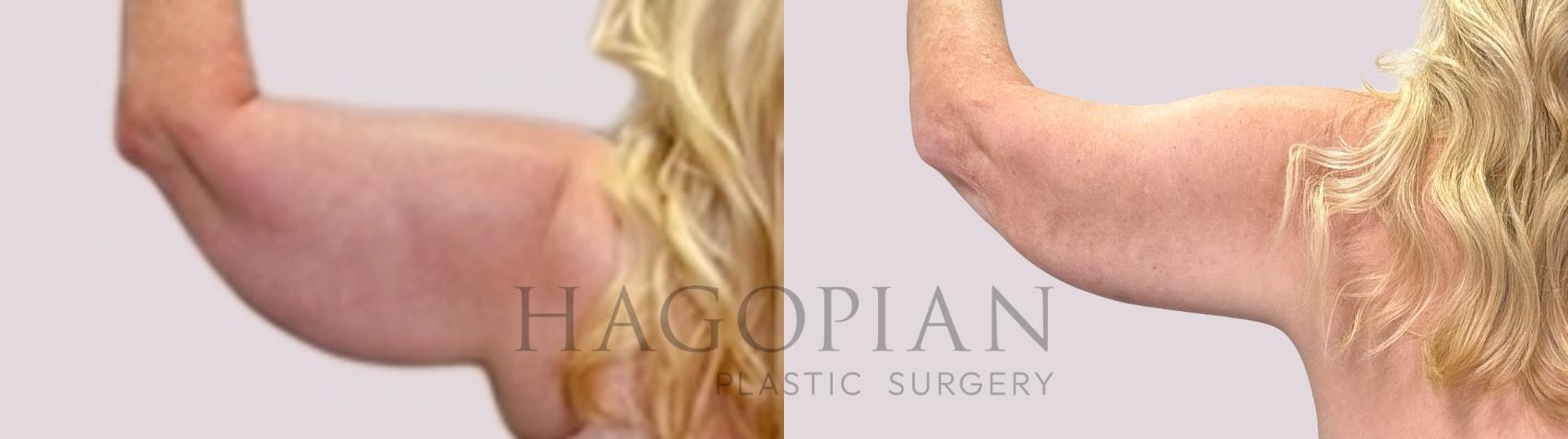 Before & After Arm Lift Case 217 Left Side View in Atlanta, GA