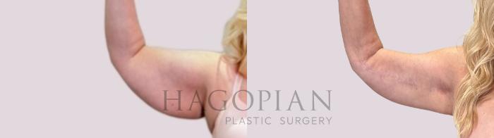 Before & After Arm Lift Case 217 Right Oblique View in Atlanta, GA