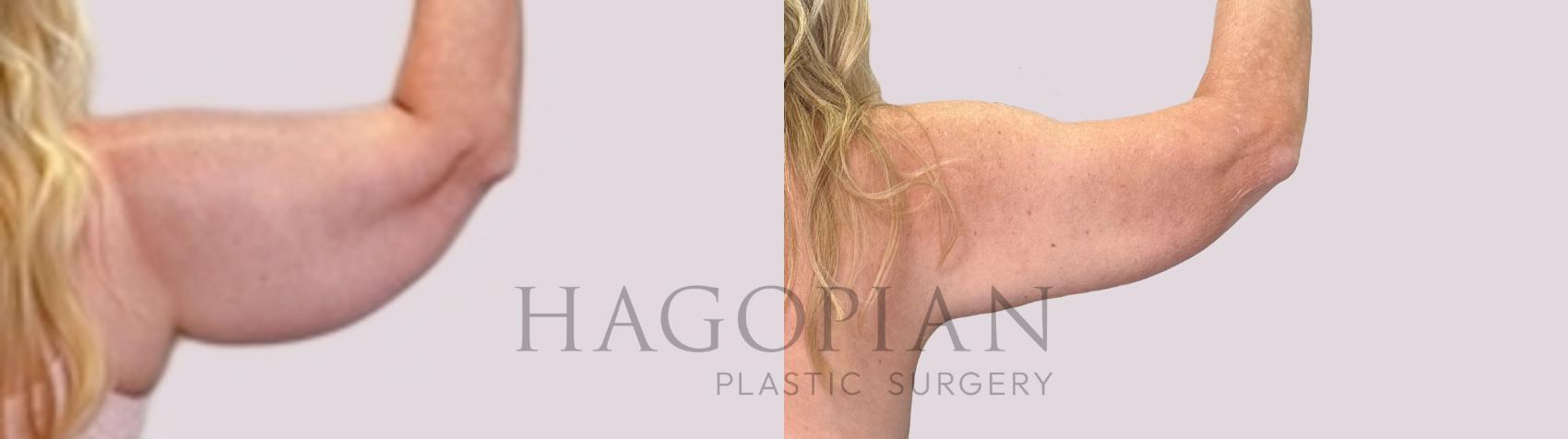 Before & After Arm Lift Case 217 Right Side View in Atlanta, GA