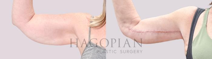 Before & After Arm Lift Case 219 Left Side View in Atlanta, GA