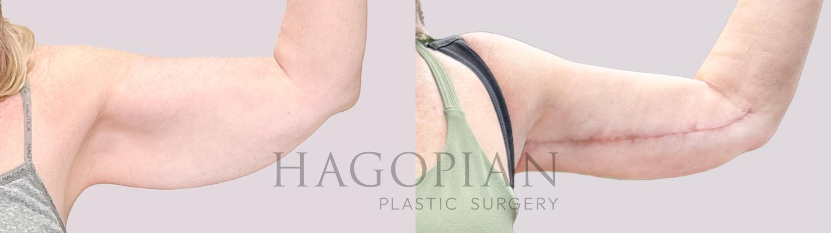 Before & After Arm Lift Case 219 Right Side View in Atlanta, GA