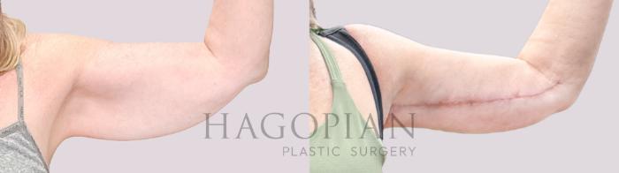Before & After Arm Lift Case 219 Right Side View in Atlanta, GA