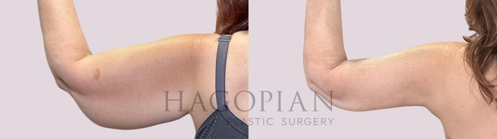 Before & After Arm Lift Case 221 Back Left View in Atlanta, GA