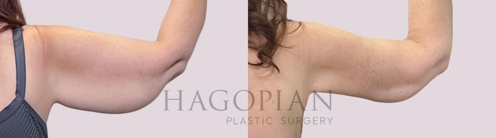 Before & After Arm Lift Case 221 Back Right View in Atlanta, GA