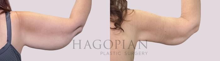 Before & After Arm Lift Case 221 Back Right View in Atlanta, GA
