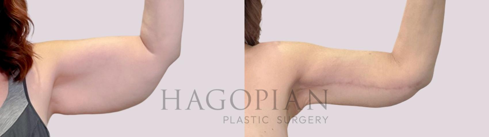 Before & After Arm Lift Case 221 Front Left View in Atlanta, GA