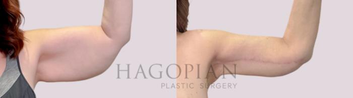 Before & After Arm Lift Case 221 Front Left View in Atlanta, GA