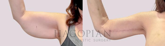 Before & After Arm Lift Case 221 Front Right View in Atlanta, GA