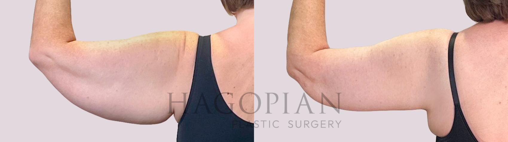 Before & After Arm Lift Case 222 Back Left View in Atlanta, GA
