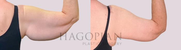 Before & After Arm Lift Case 222 Back Right View in Atlanta, GA