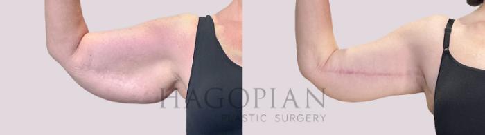 Before & After Arm Lift Case 222 Left Front  View in Atlanta, GA