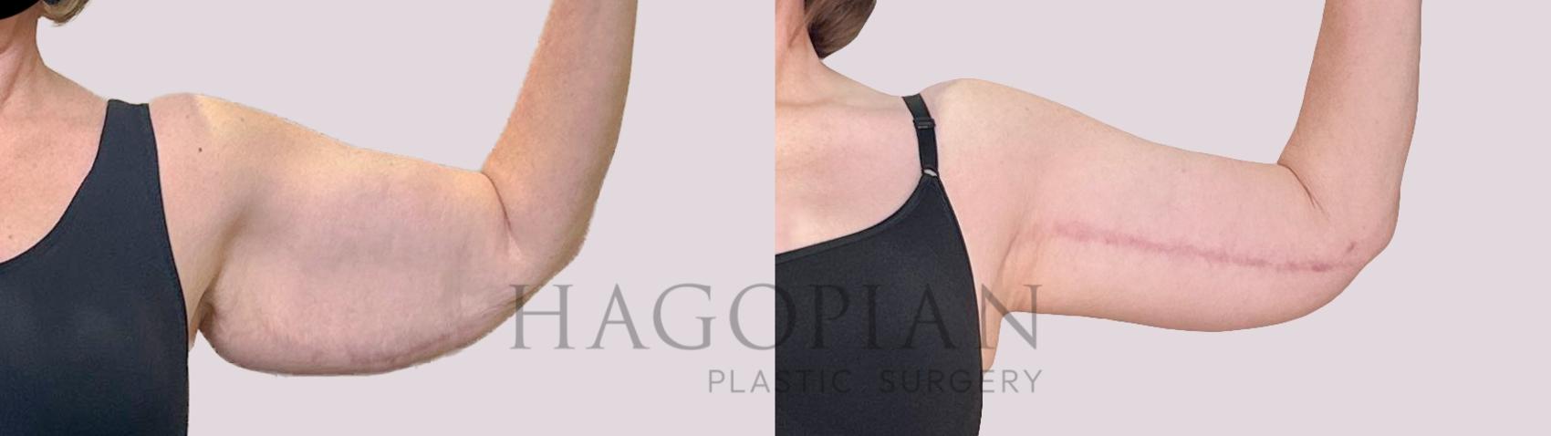 Before & After Arm Lift Case 222 Right front View in Atlanta, GA