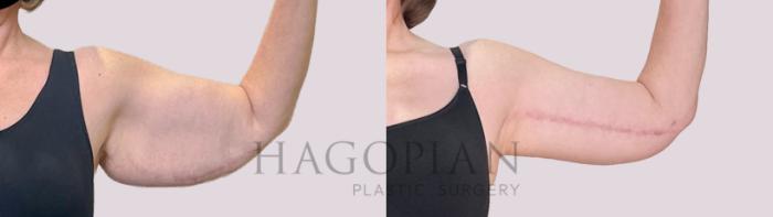 Before & After Arm Lift Case 222 Right front View in Atlanta, GA