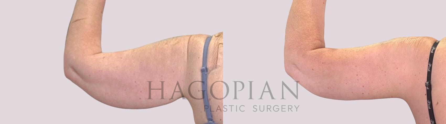 Before & After Arm Lift Case 225 Back Left View in Atlanta, GA