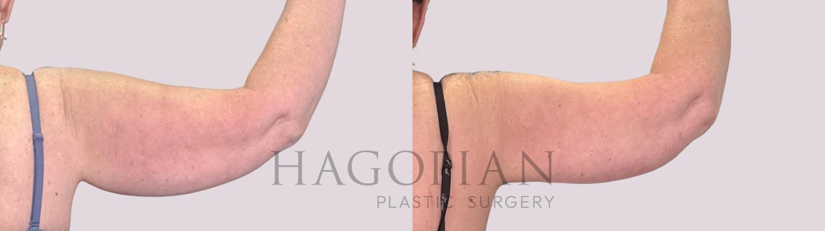 Before & After Arm Lift Case 225 Back Right View in Atlanta, GA