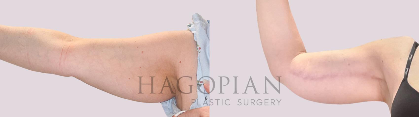 Before & After Arm Lift Case 225 Front Left View in Atlanta, GA