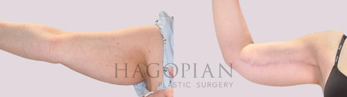 Before & After Arm Lift Case 225 Front Left View in Atlanta, GA
