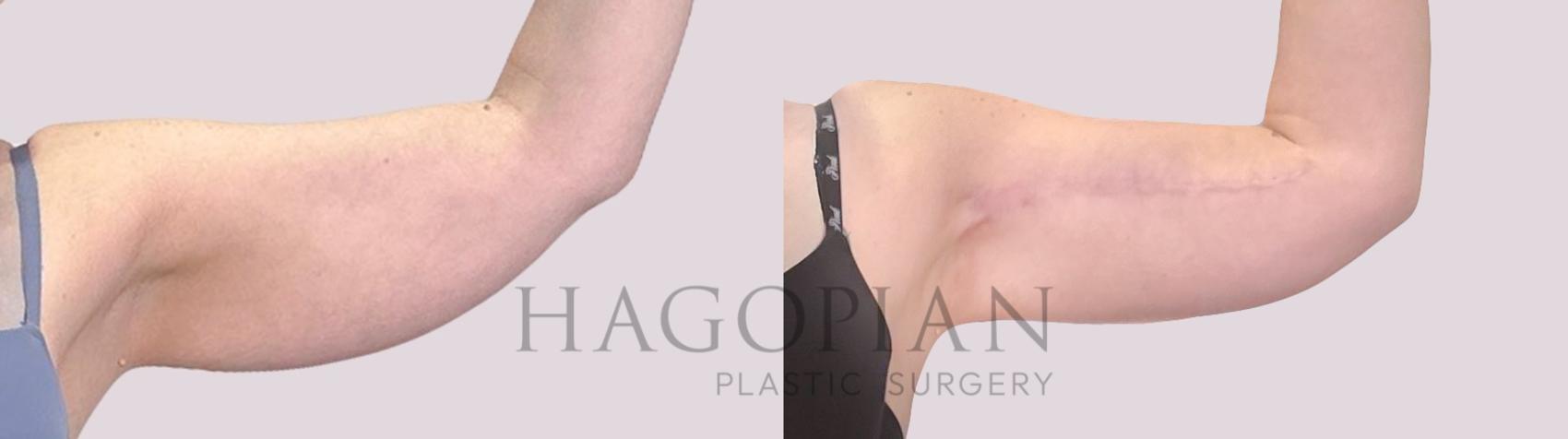 Before & After Arm Lift Case 225 Front Right View in Atlanta, GA