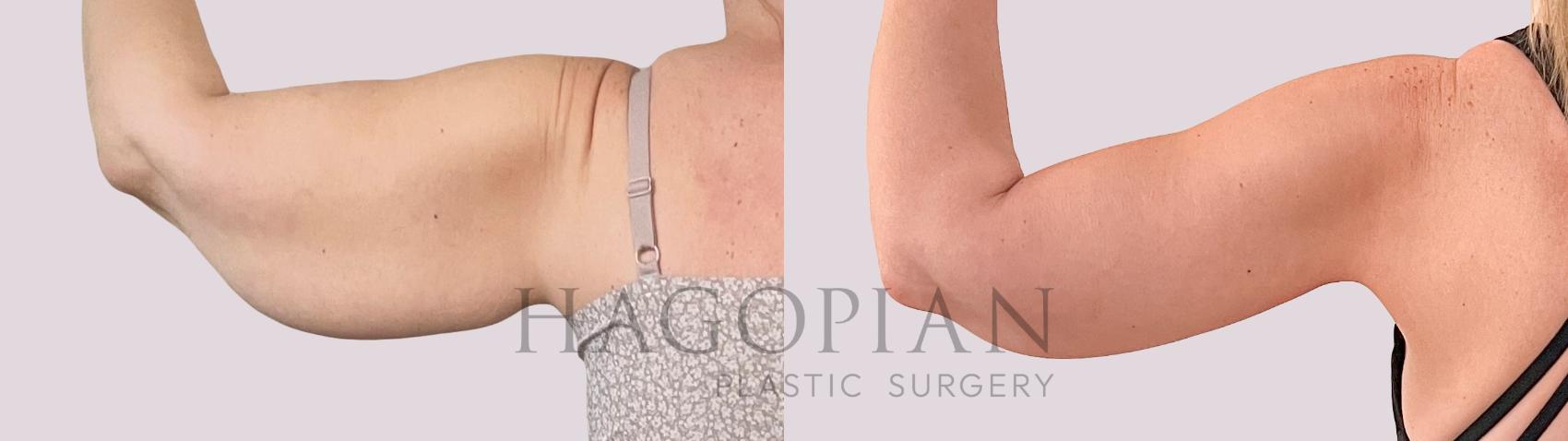Before & After Arm Lift Case 231 Back Left View in Atlanta, GA