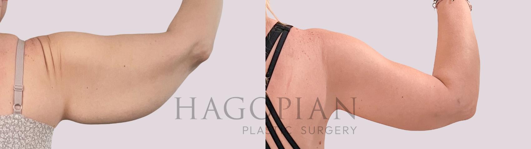 Before & After Arm Lift Case 231 Back Right View in Atlanta, GA