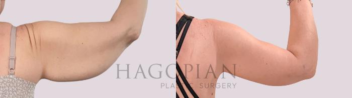 Before & After Arm Lift Case 231 Back Right View in Atlanta, GA