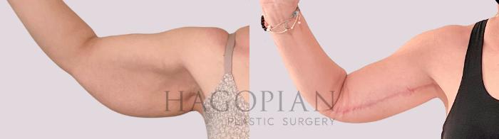 Before & After Arm Lift Case 231 Front Left View in Atlanta, GA