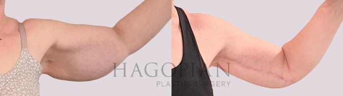 Before & After Arm Lift Case 231 Front Right View in Atlanta, GA