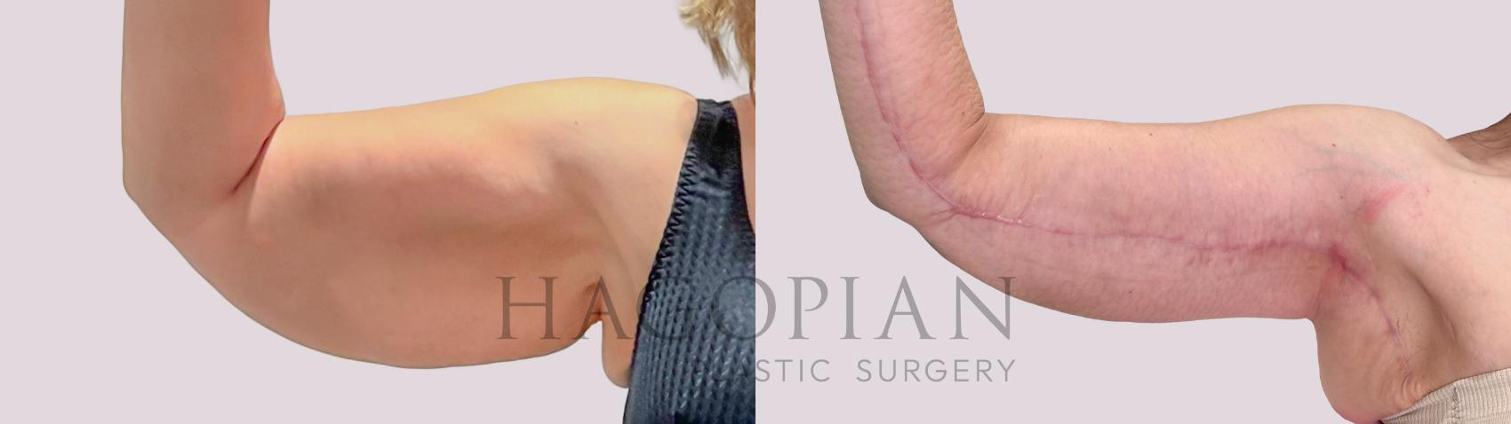 Before & After Arm Lift Case 233 Left Side View in Atlanta, GA