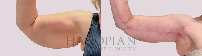 Before & After Arm Lift Case 233 Left Side View in Atlanta, GA