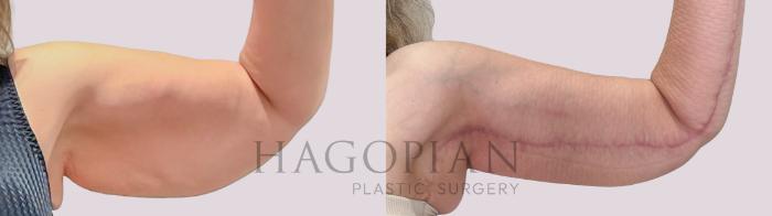 Before & After Arm Lift Case 233 Right Side View in Atlanta, GA