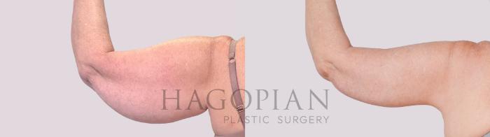 Before & After Arm Lift Case 234 Back Left View in Atlanta, GA