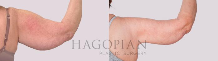 Before & After Arm Lift Case 234 Back Right View in Atlanta, GA