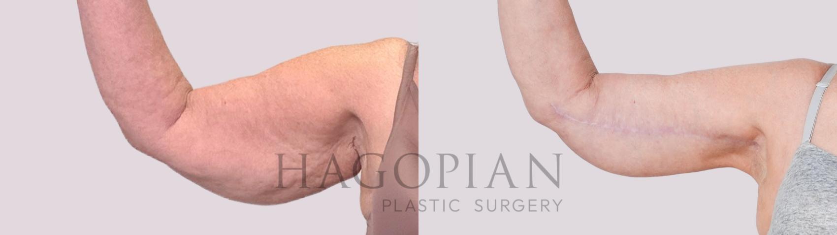 Before & After Arm Lift Case 234 Front Left View in Atlanta, GA