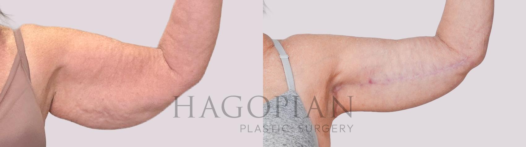 Before & After Arm Lift Case 234 Front Right View in Atlanta, GA