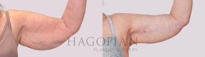 Before & After Arm Lift Case 234 Front Right View in Atlanta, GA