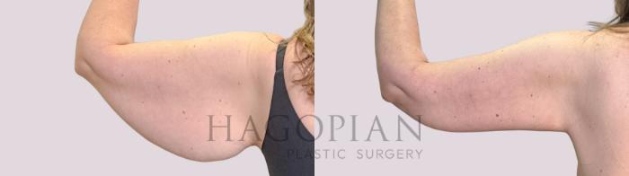 Before & After Arm Lift Case 241 Back Left View in Atlanta, GA