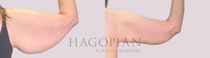 Before & After Arm Lift Case 241 Back Right View in Atlanta, GA
